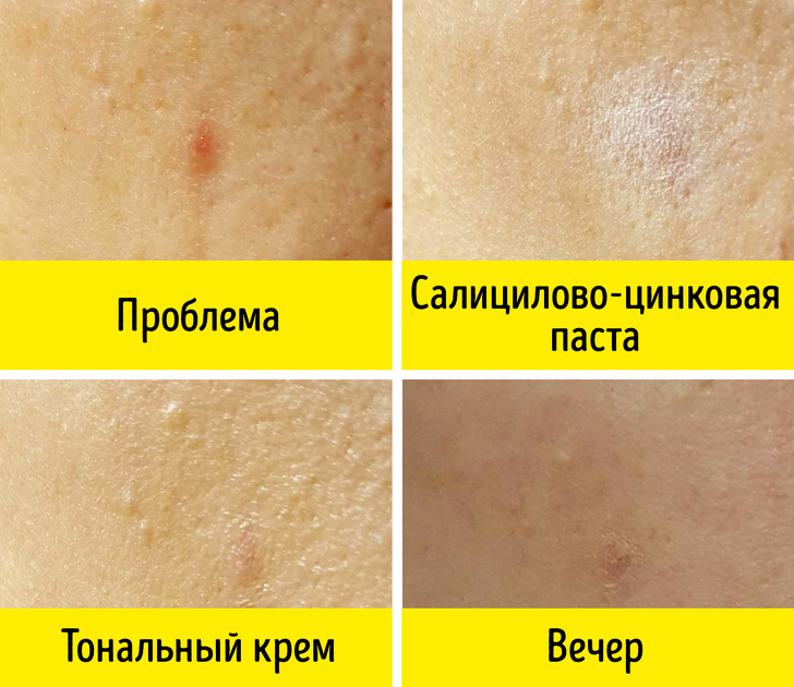 Salicylic Zinc Paste - Günstige Medikamente aus Apotheken, die genauso gut funktionieren wie teure Kosmetika Салицилово-цинковая паста - Бюджетные средства из аптеки, не хуже дорогой косметики