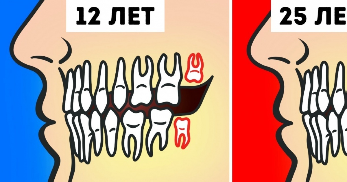 Müssen Sie wirklich Weisheitszähne entfernen? Удалять или нет зубы мудрости