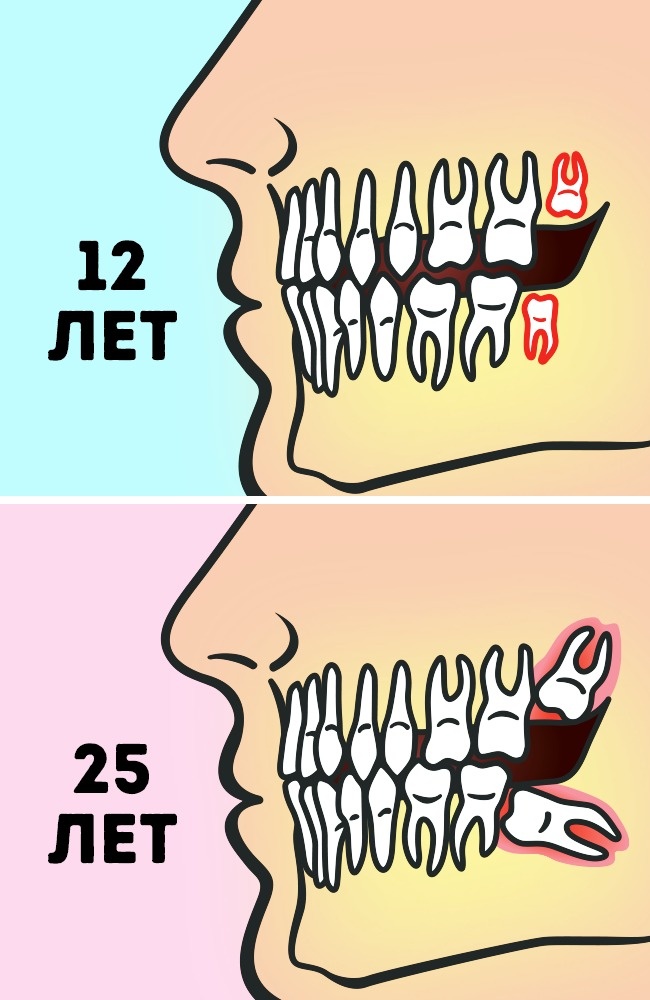 Müssen Sie wirklich Weisheitszähne entfernen? Удалять или нет зубы мудрости
