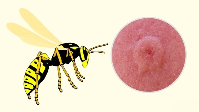 Wasp - Wie man erkennt, welches Insekt dich gebissen hat Оса - Чей это укус?