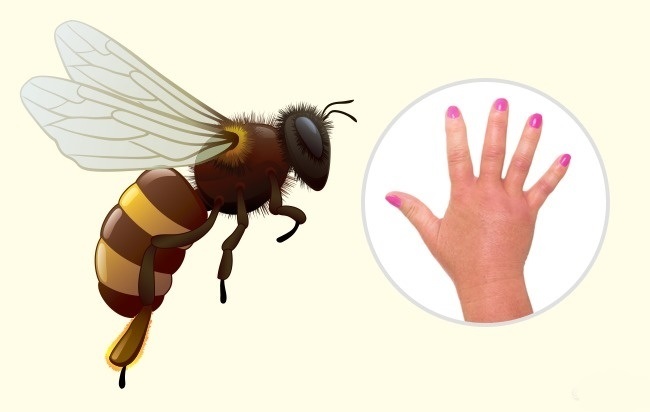 Hornet - Wie man erkennt, welches Insekt dich gebissen hat Шершень - Чей это укус?