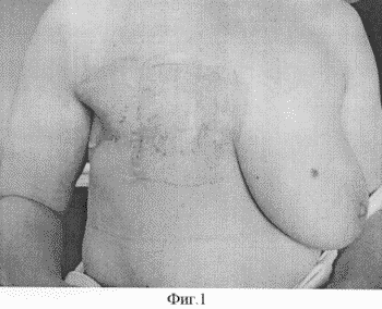 VERFAHREN ZUR BEHANDLUNG VON LOCAL RELAPSE des Brustkrebses. Russische Föderation Patent RU2286818