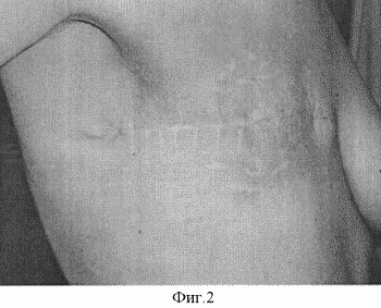 VERFAHREN ZUR BEHANDLUNG VON LOCAL RELAPSE des Brustkrebses. Russische Föderation Patent RU2286818