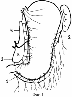 METHODE Gastrectomy